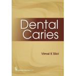 Dental Caries 